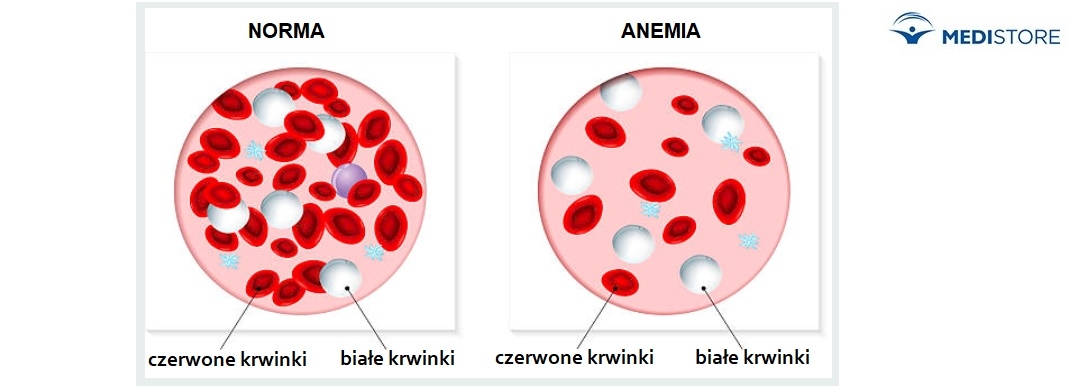 anemia diagnoza