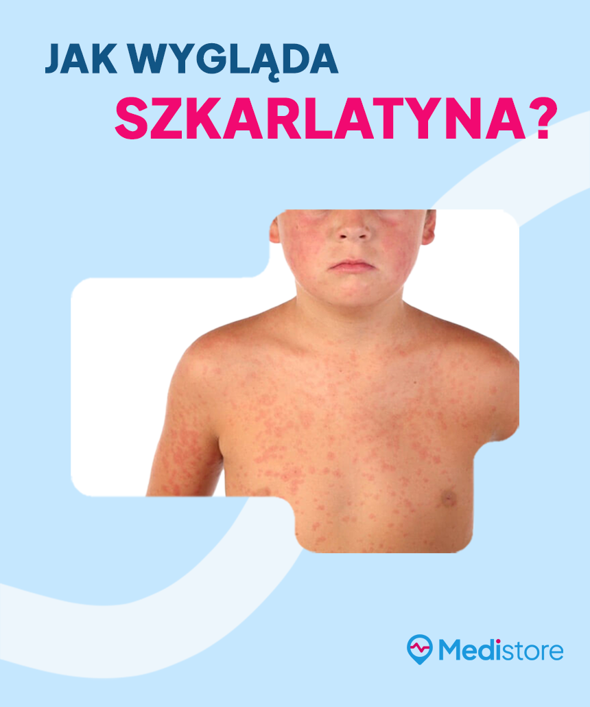Szkarlatyna – objawy u dzieci i dorosłych. Objawy choroby to m.in. wysypka, silny ból gardła, biały nalot na języku.