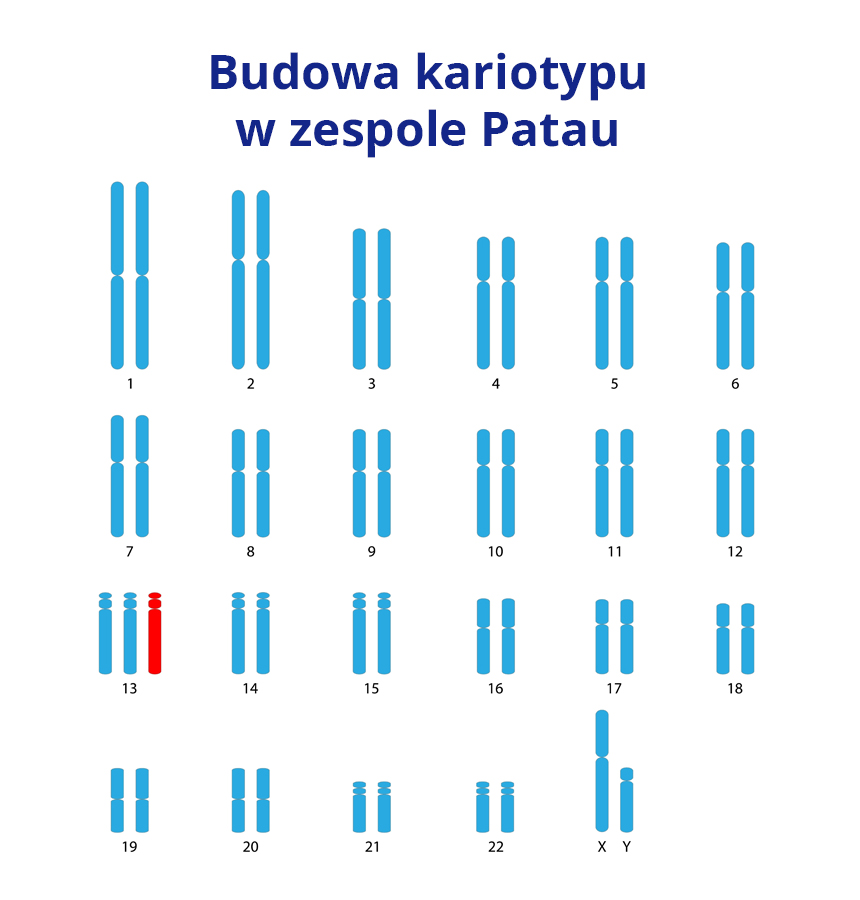 Zespół Patau jest chorobą genetyczną związaną z nieprawidłowością kariotypu, czyli obecnością dodatkowego chromosomu 13 w kompletach chromosomów człowieka.